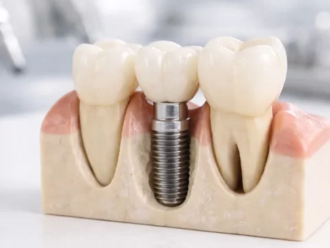 Can Dental Implants Help Prevent Bone Loss?